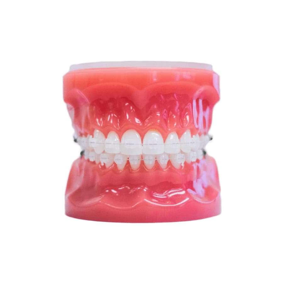 Clear Aligners