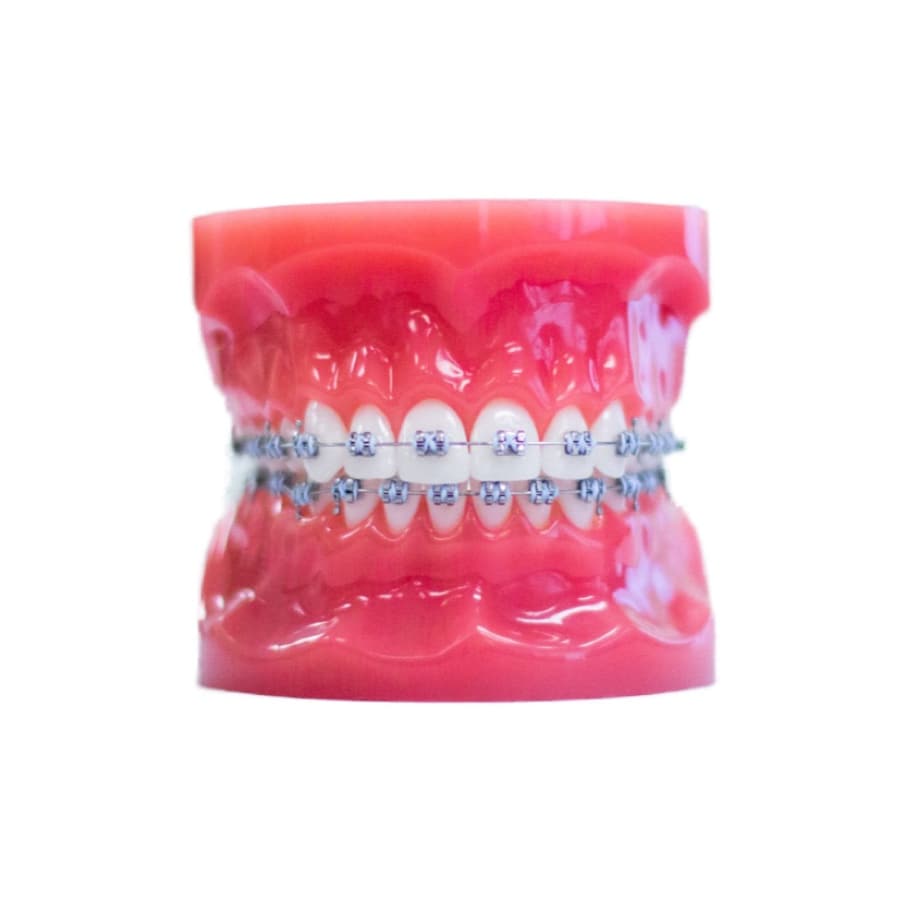 Clear Aligners