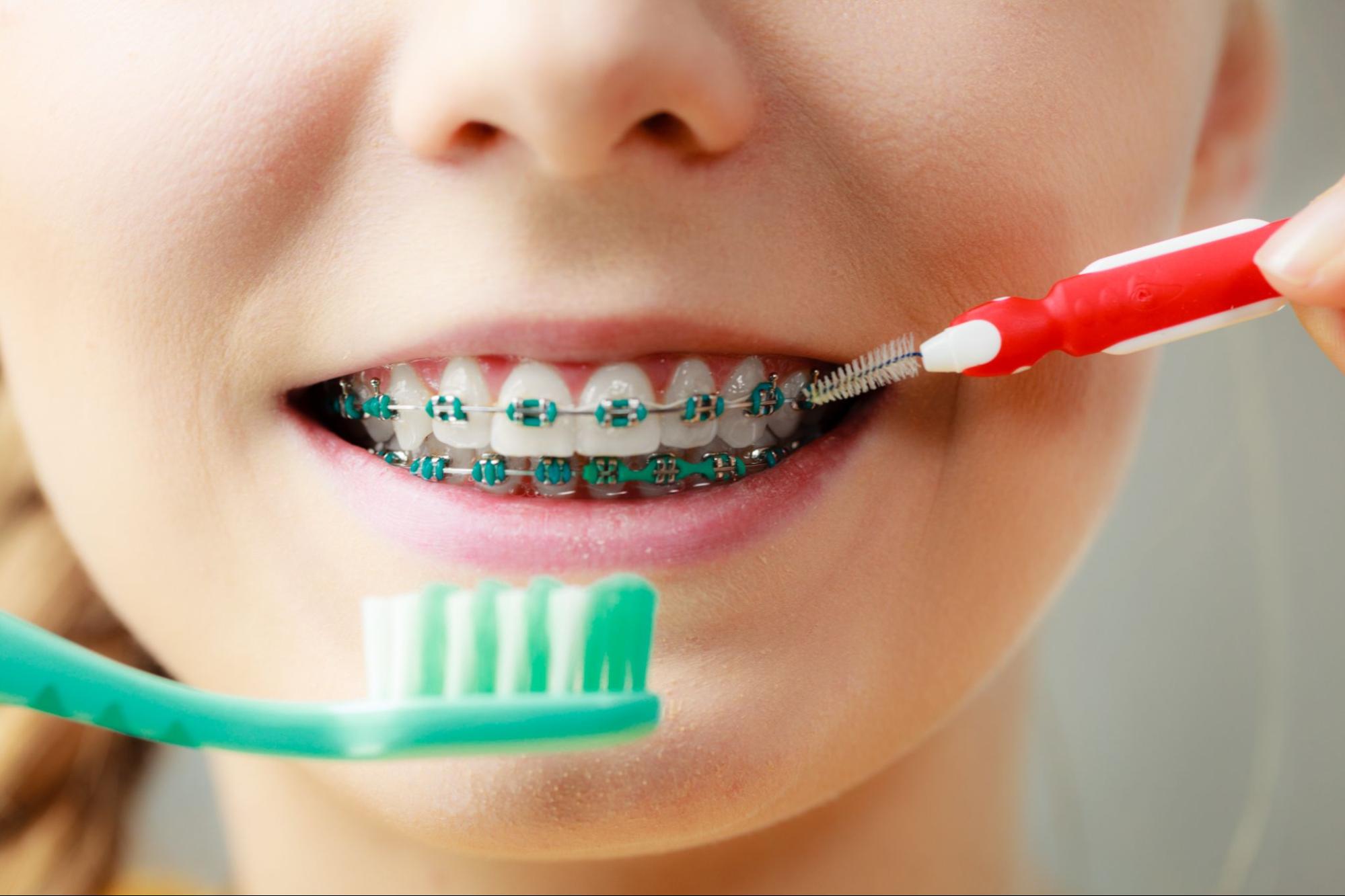 Braces Care Tips for Bayboro and Sanford Smiles